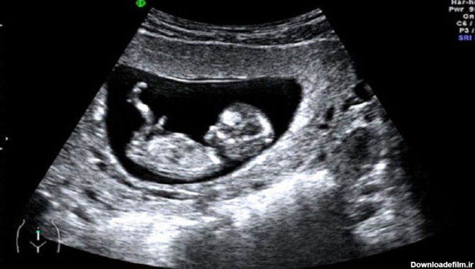 سونوگرافی تعیین جنسیت (جنین دختر است یا پسر؟) سونوگرافی پستان ...
