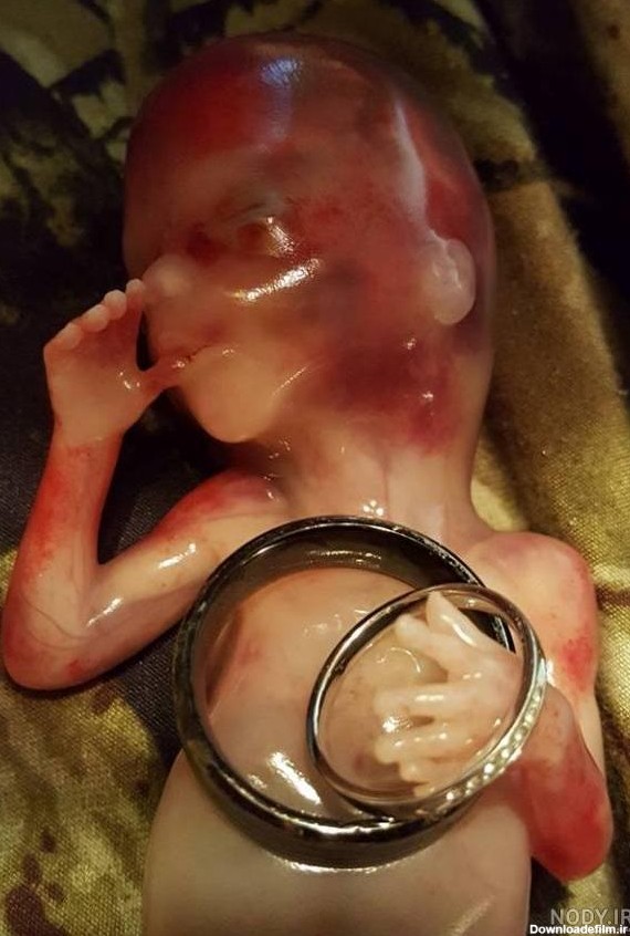 عکس جنین پسر سقط شده