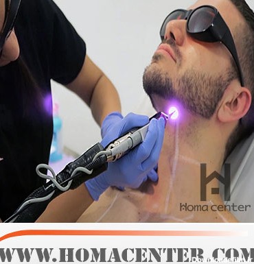 بررسی کامل لیزر موی صورت مردان - هما سنتر