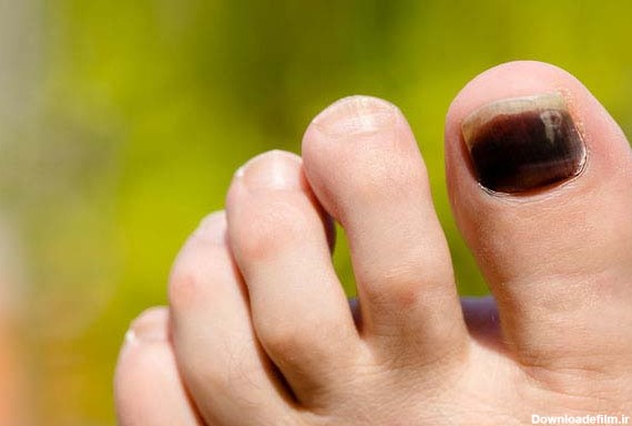 6 علت سیاه شدن ناخن شست پا و راه‌های درمان آن - مجله وبسایت آچاره