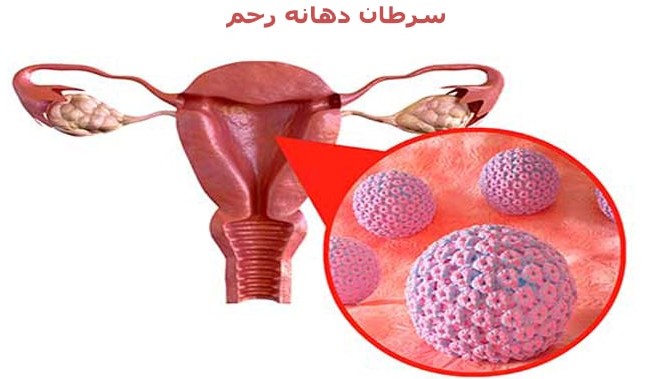 [تصویر:  uterus-cancer.jpg]