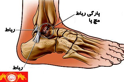 ﭘﯿﭻ ﺧﻮردﮔﯽ ﻣﭻ ﭘﺎ ( Ankle sprain )