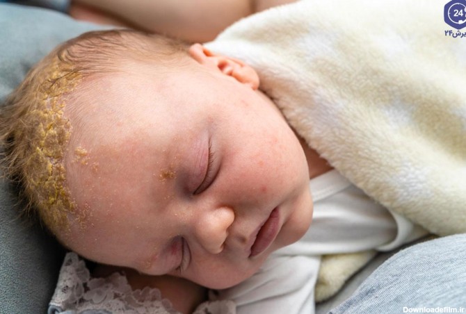درمان پوست ریزی سر نوزاد