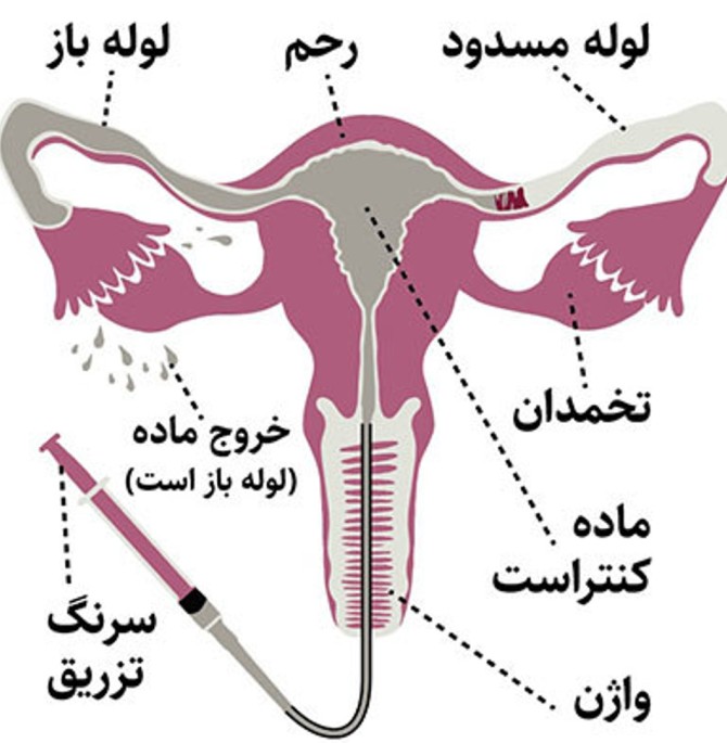 عکس رنگی رحم تبریز