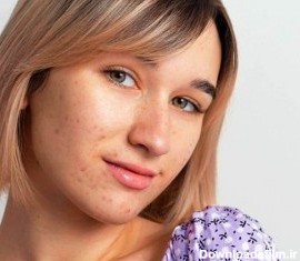 دقیقا کجای صورتت جوش میزنه؟ + دلیل و درمان