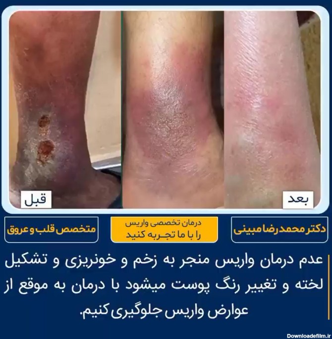 درمان زخم پا نمونه کار شماره 2 در تهران همرا با عکس
