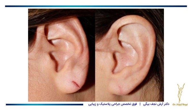 جراحی زیبایی نرمه گوش یا لوبو پلاستی | کلینیک جراحی دکتر آرش نجف بیگی