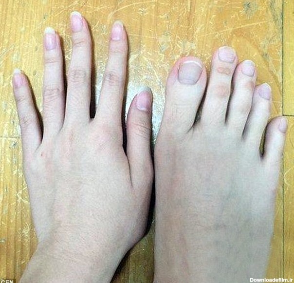 دختری که انگشتان دست و پایش هم‌اندازه‌اند!+عکس