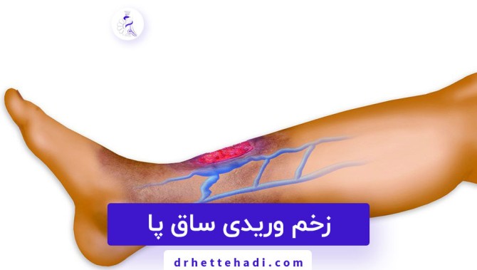 زخم وریدی ساق پا￼ | متخصص ارتوپدی در شیراز - دکتر حسین اتحادی
