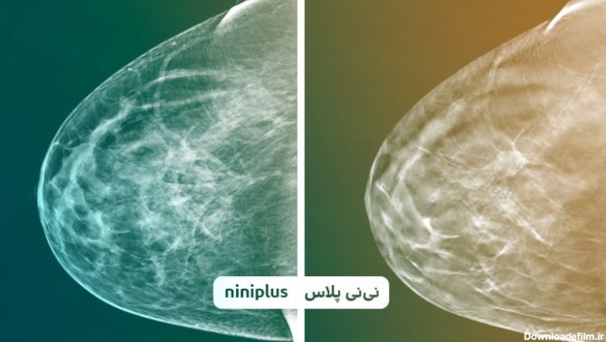تفسیر جواب ماموگرافی و جواب ماموگرافی چقدر طول میکشه؟ | نی نی پلاس