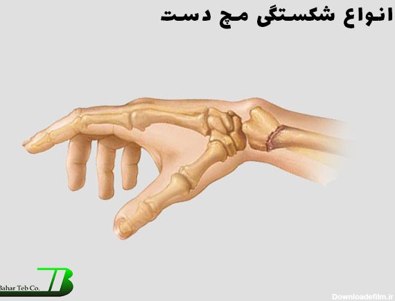 انواع شکستگی مچ دست