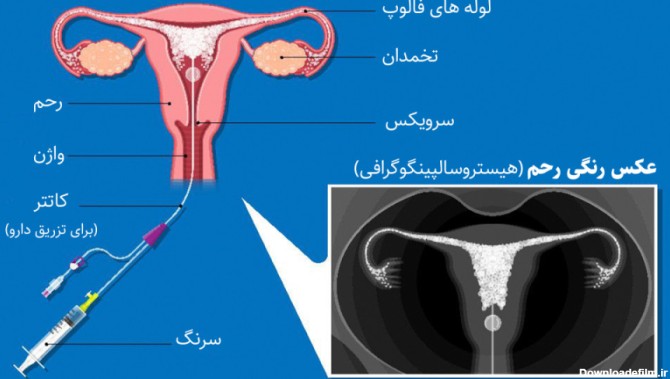 عکس رنگی رحم تخمدان