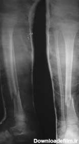 عکس رادیولوژی شکستگی ساق پا