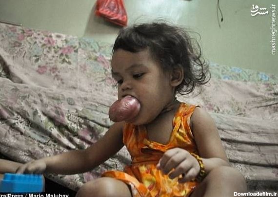 تومور عجیب در دهان دختر فیلیپینی+عکس - مشرق نیوز