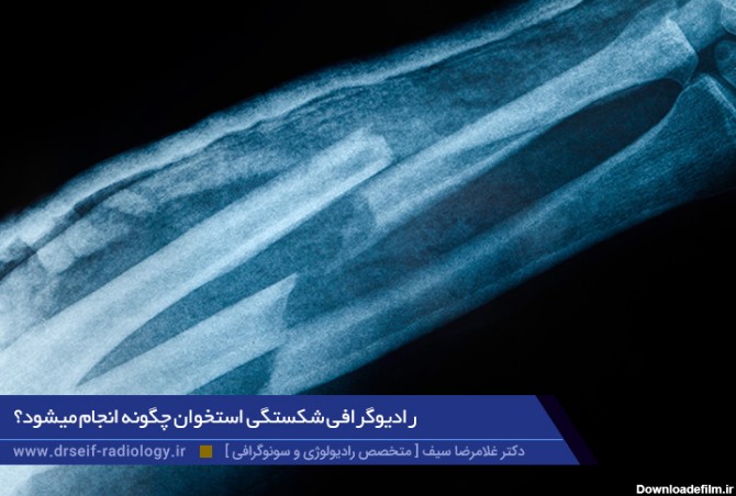 تشخیص شکستگی استخوان با رادیوگرافی