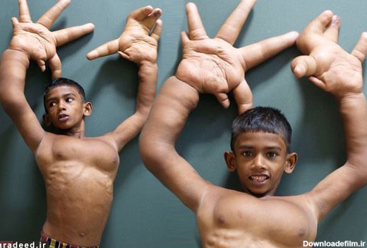 بیماری عجیب پسر بچه هندی +عکس