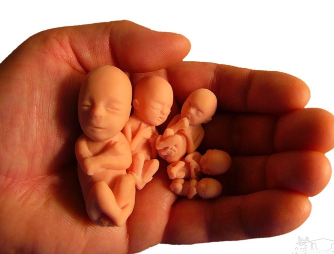 علائم و نشانه های سقط و مردن جنین در شکم