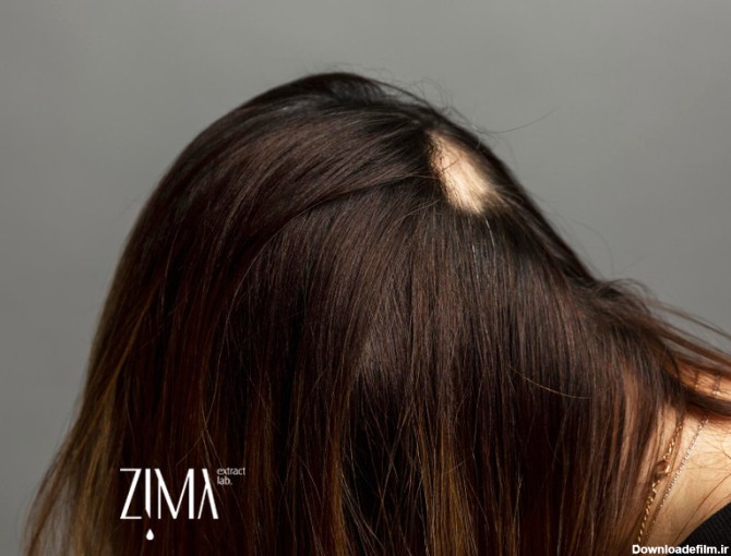ریزش مو سکه ای (آلوپسی) چیست؟ + علت و درمان آن | زیمالب