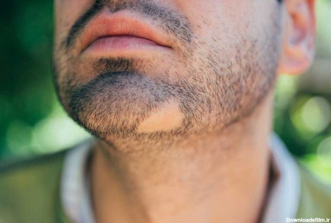 عوامل ریزش مو سکه ای و روش های درمانی آن | کلینیک تخصصی پوست ...