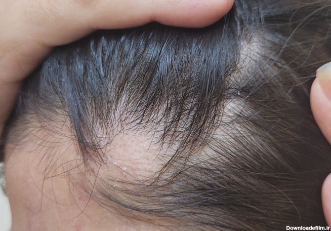 ردپای محکم استرس در ریزش موی سکه‌ای: – کلینیک پوست و زیبایی