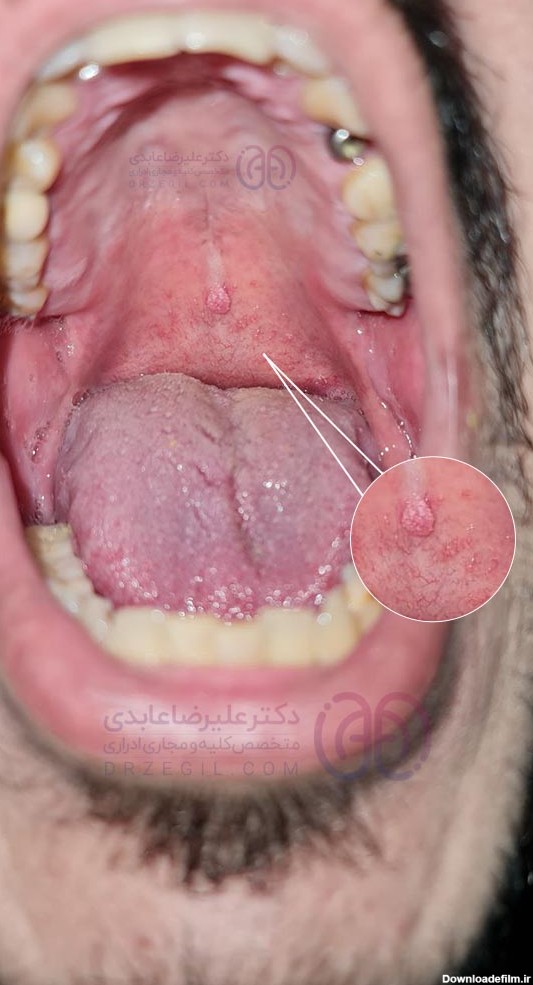 درمان زگیل دهانی + عکس زگیل دهانی 1402 و زگیل زبان