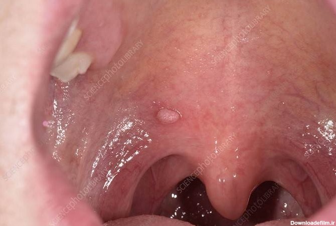 زگیل دهانی (زگیل تناسلی در دهان) چگونه منتقل می شود؟ - متخصص پوست ...