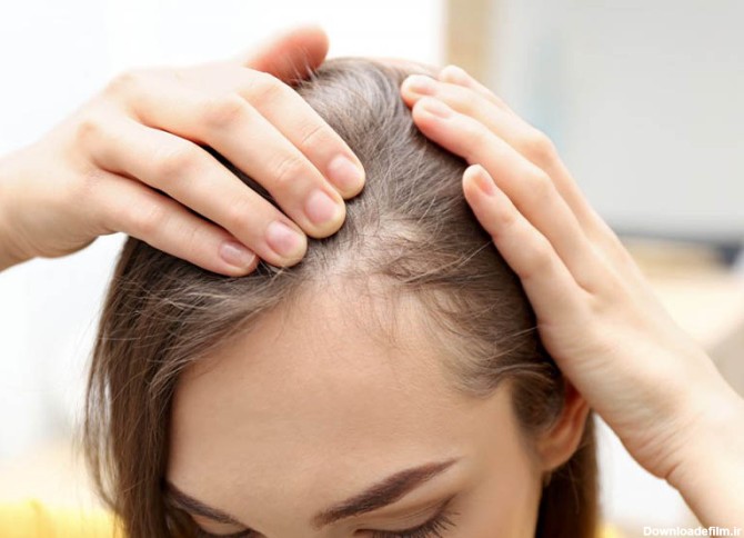 ریزش مو سکه‌ای چیست؟+ درمان و علت آن | روژا شاپ