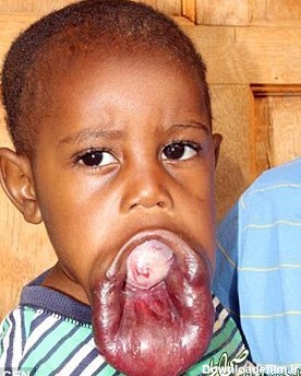رشد غیر طبیعی دهان یک کودک + عکس