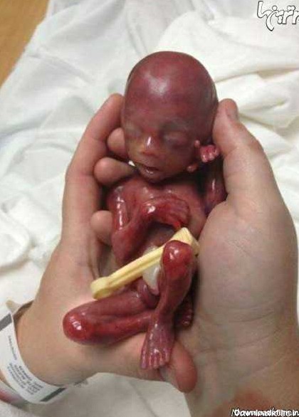 به دنیا آمدن جنین | عکس های تولد جنین شش ماهه