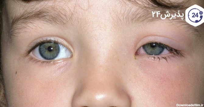 علت التهاب چشم کودکان چیست؟ معرفی انواع راه های درمان آن | پذیرش۲۴