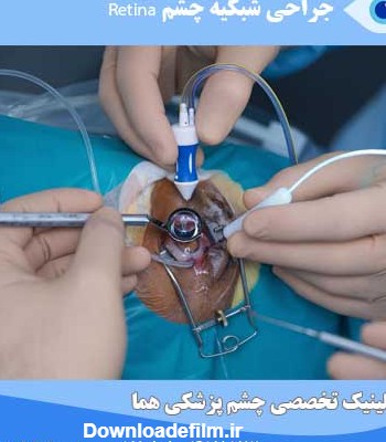 جراحی شبکیه چشم | عمل شبکیه چشم در تهران |درمان بیماری شبکیه