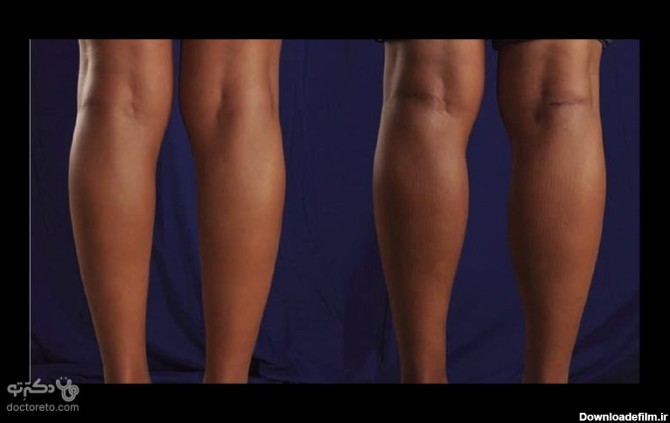آیا تزریق ژل به ساق و مچ پا روش مناسبی برای زیباسازی بدن است؟