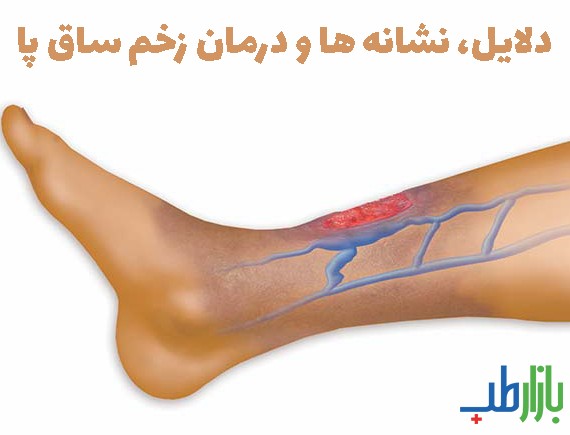 زخم ساق پا | درمان زخم ساق پا | درمان زخم | درمان زخم پا | زخم