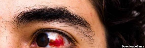 خونریزی چشم را چگونه در خانه درمان کنیم؟ | لنز و عینک لوناتو