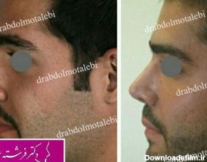 نتیجه جراحی بینی مردانه قبل و بعد