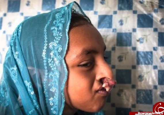 بیماری عجیبی که چهره دختر زاهدانی را تخریب کرد +تصاویر