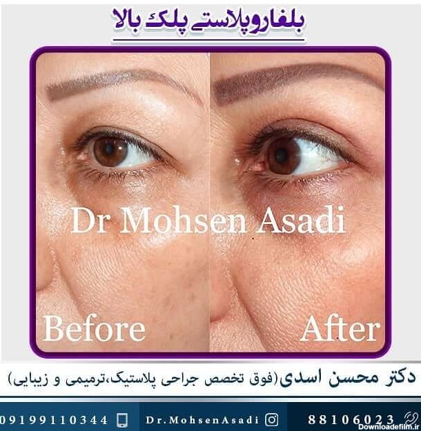 آشنایی با جراحی زیبایی پلک یا بلفاروپلاستی | دکتر محسن اسدی