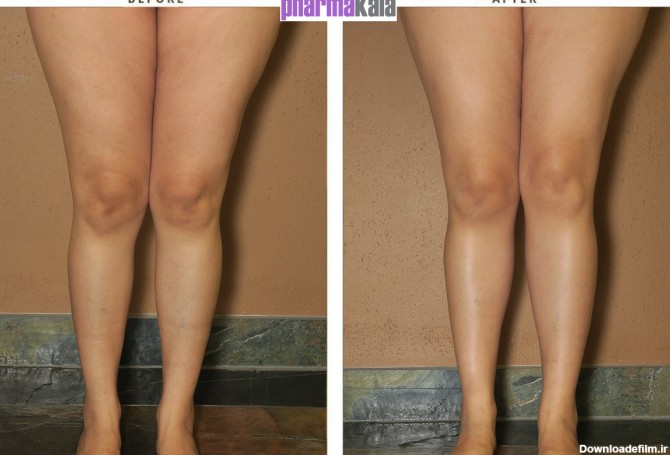 روش های زیبا سازی ساق پا – فارماکالا
