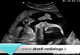 تشخیص سقط جنین با سونوگرافی