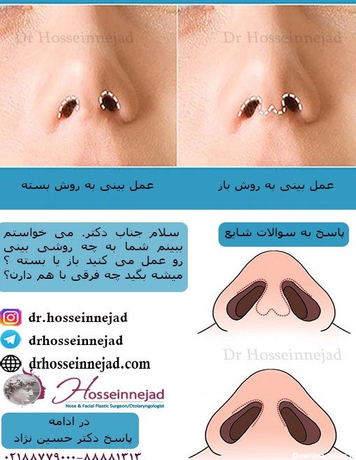انواع جراحی بینی