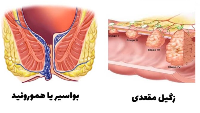 عکس زگیل مقعدی مردان