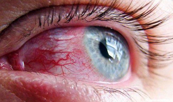 خونریزی شبکیه | کلینیک چشم پزشکی هما