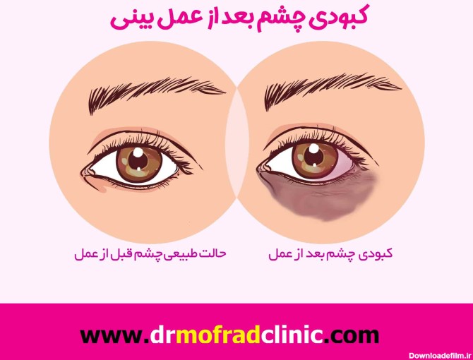کبودی چشم بعد از جراحی بینی - دکتر امیر حسین محمدی مفرد