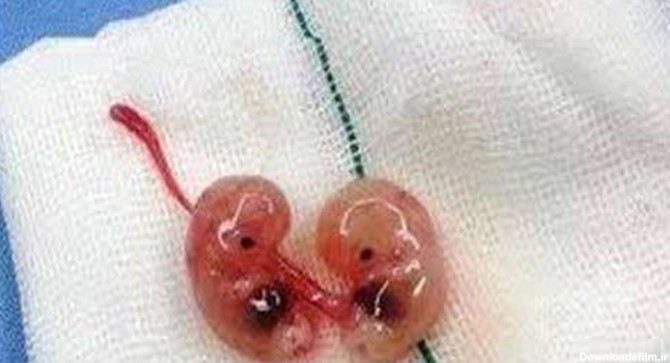 سقط جنین بخاطر حفظ زیبایی!