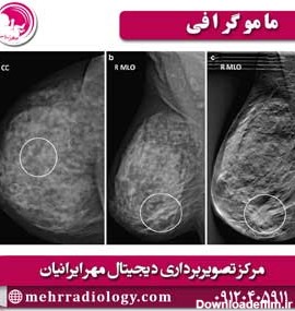 ماموگرافی | رادیولوژی در تهران | کلینیک سونوگرافی مهر ایرانیان