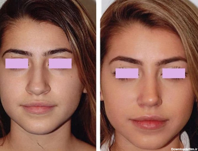 عکس قبل و بعد عمل بینی گوشتی و پهن