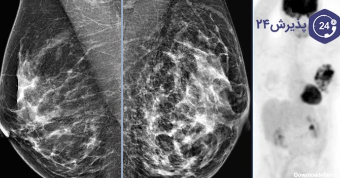 ماموگرافی چیست و برای چه انجام می‌شود؟ | پذیرش۲۴