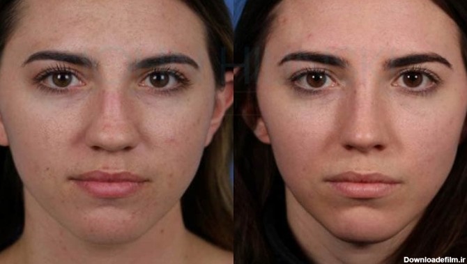 تصاویر بینی گوشتی قبل و بعد عمل