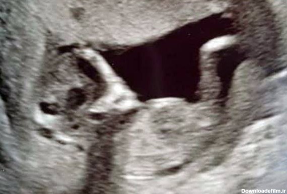 چشمان ترسناک یک جنین در شکم مادرش ! / زن خارجی شوکه شد! + عکس