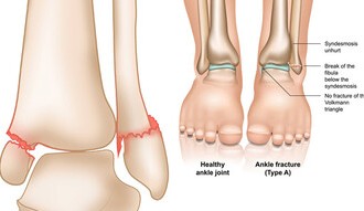 پزشک متخصص چگونه شکستگی مچ پا را تشخیص می‌دهد؟